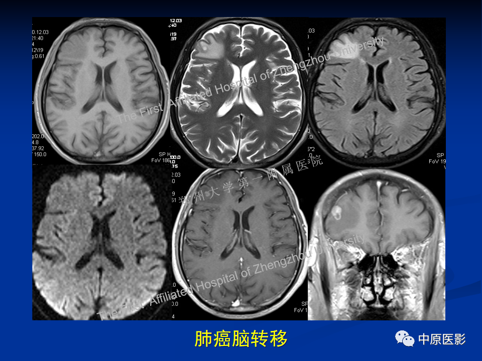 影像PPT - 【病例】脱髓鞘假瘤1例MR影像-29