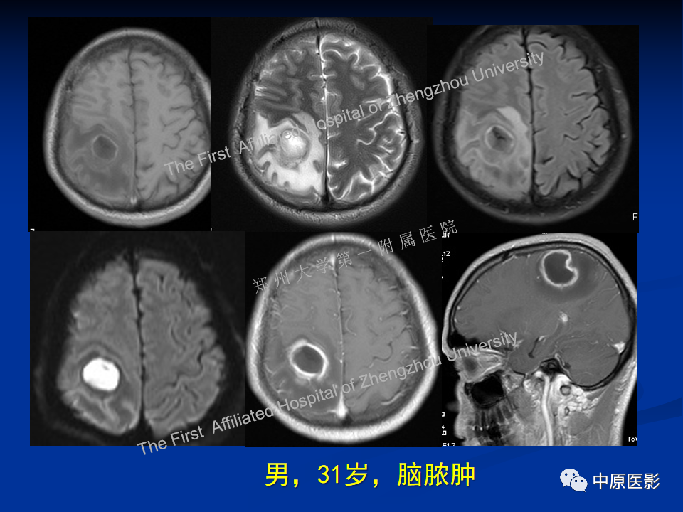 影像PPT - 【病例】脱髓鞘假瘤1例MR影像-31