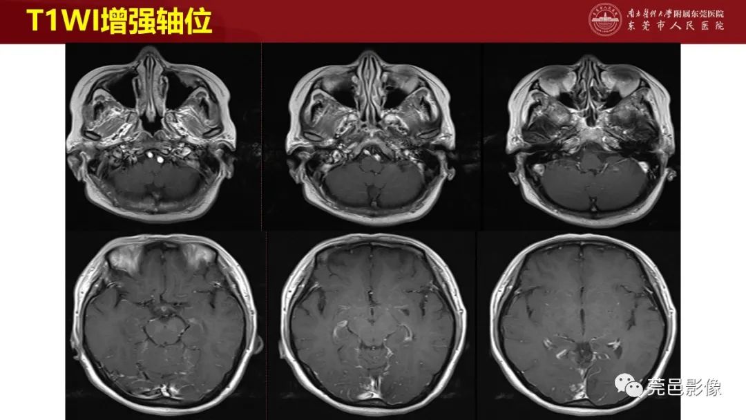 影像PPT - 【PPT】特鲁索综合征影像诊断-13