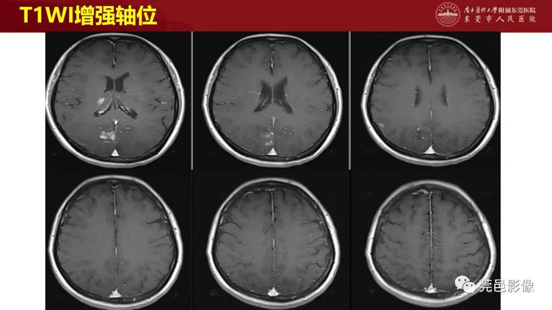 影像PPT - 【PPT】特鲁索综合征影像诊断-14