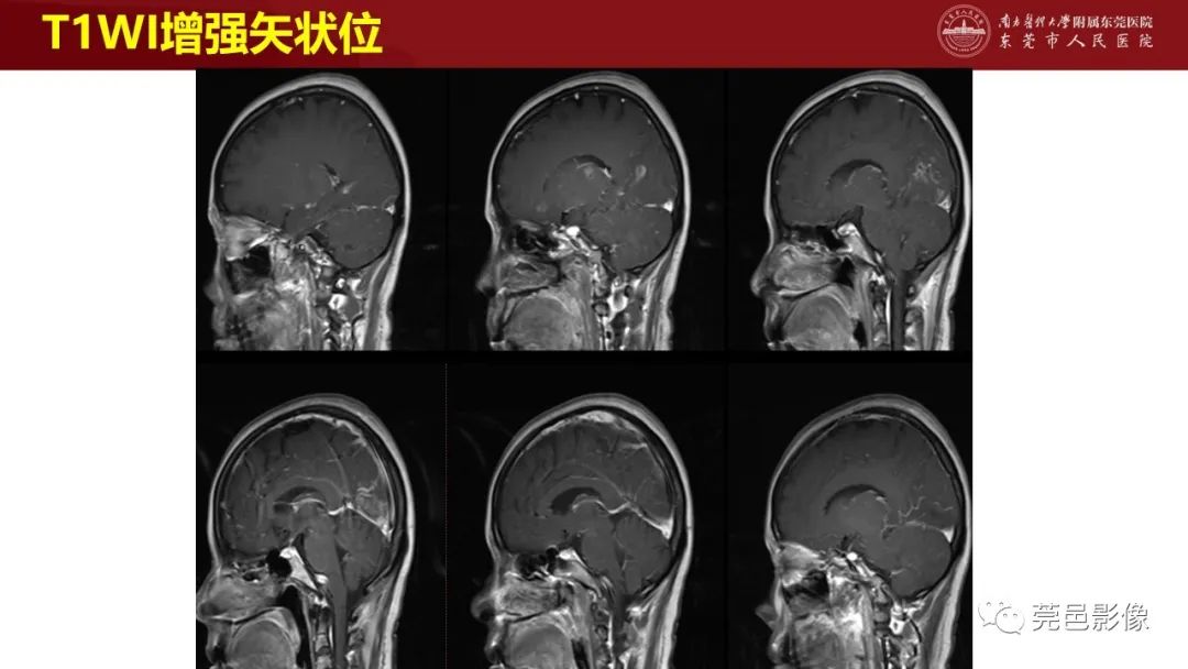 影像PPT - 【PPT】特鲁索综合征影像诊断-15