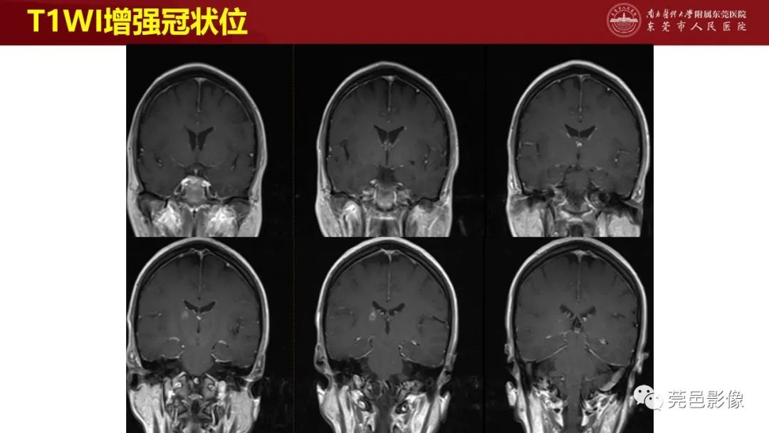 影像PPT - 【PPT】特鲁索综合征影像诊断-16