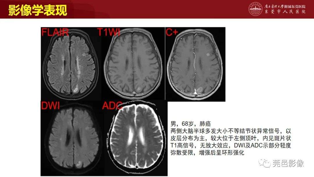 影像PPT - 【PPT】特鲁索综合征影像诊断-24