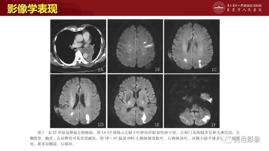 影像PPT - 【PPT】特鲁索综合征影像诊断-25