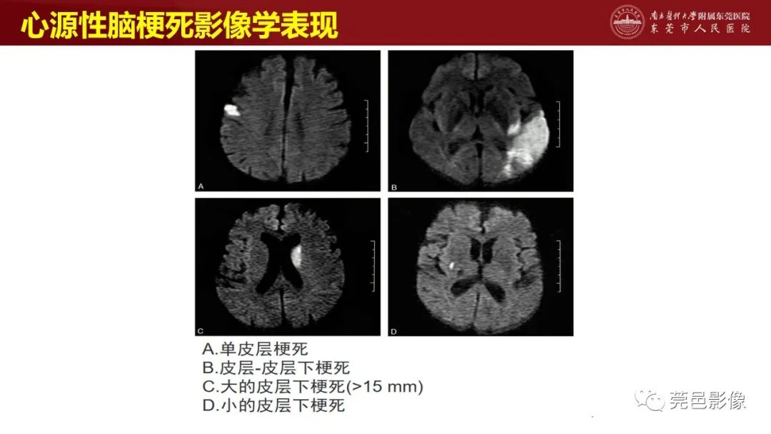影像PPT - 【PPT】特鲁索综合征影像诊断-29