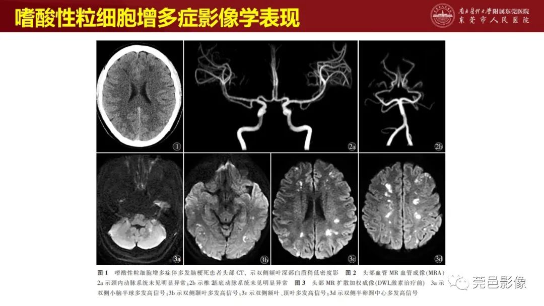 影像PPT - 【PPT】特鲁索综合征影像诊断-32
