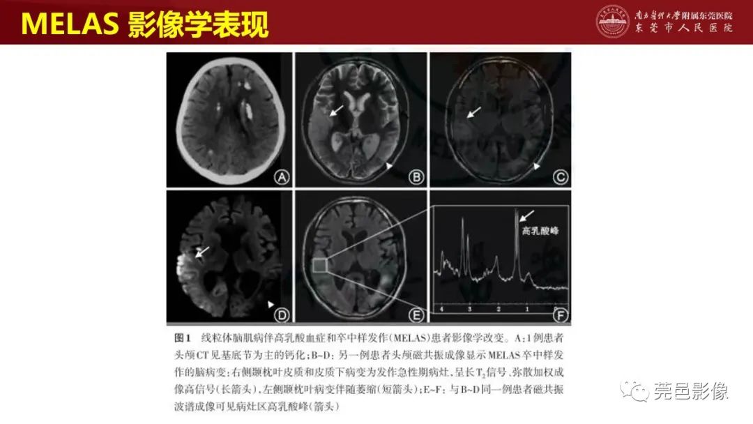 影像PPT - 【PPT】特鲁索综合征影像诊断-35