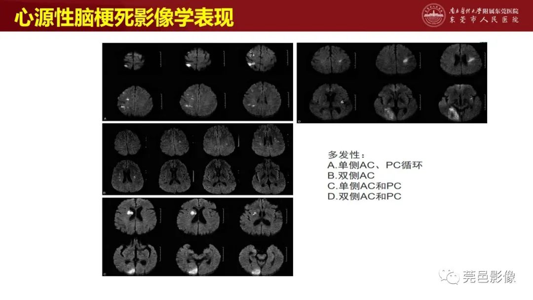 影像PPT - 【PPT】特鲁索综合征影像诊断-30