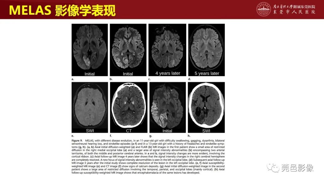 影像PPT - 【PPT】特鲁索综合征影像诊断-36