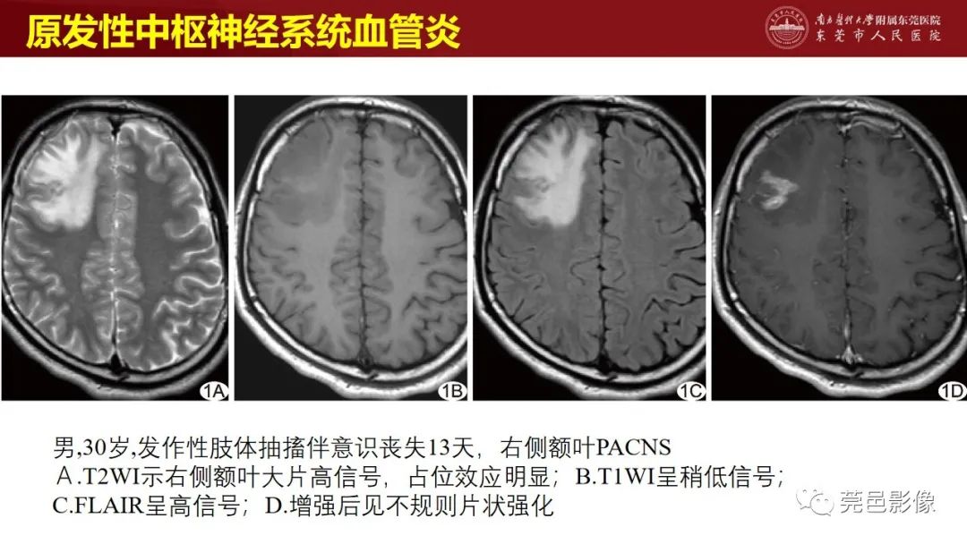 影像PPT - 【PPT】特鲁索综合征影像诊断-38