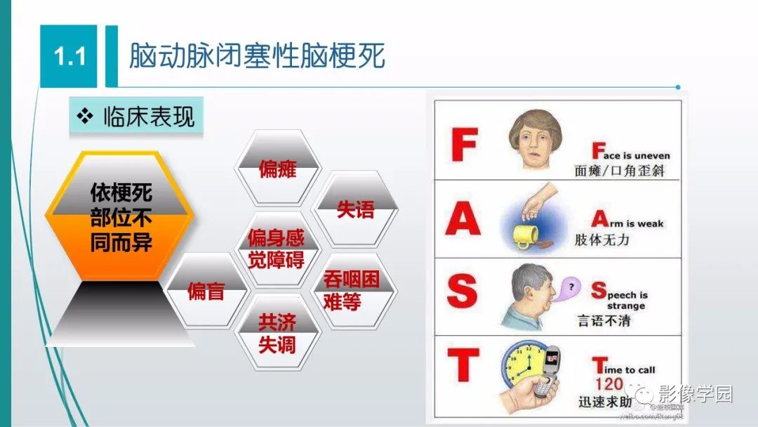 影像PPT - 【PPT】脑血管疾病的影像学诊断-6