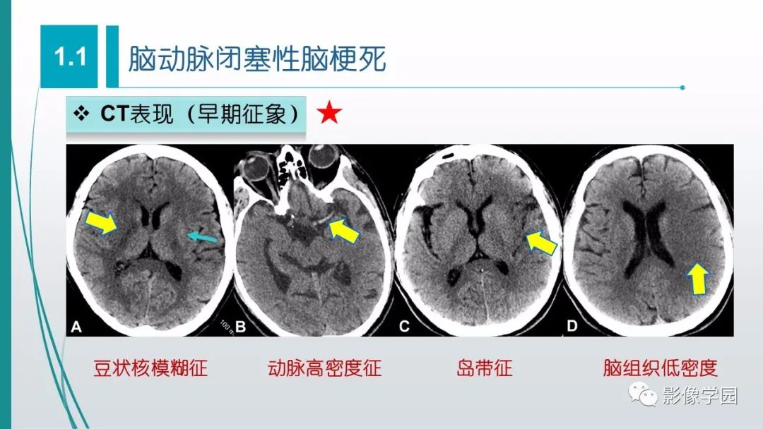 影像PPT - 【PPT】脑血管疾病的影像学诊断-9