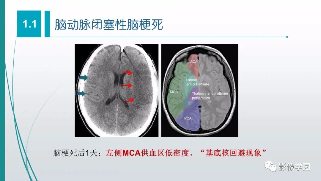影像PPT - 【PPT】脑血管疾病的影像学诊断-11
