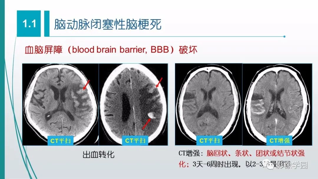 影像PPT - 【PPT】脑血管疾病的影像学诊断-13