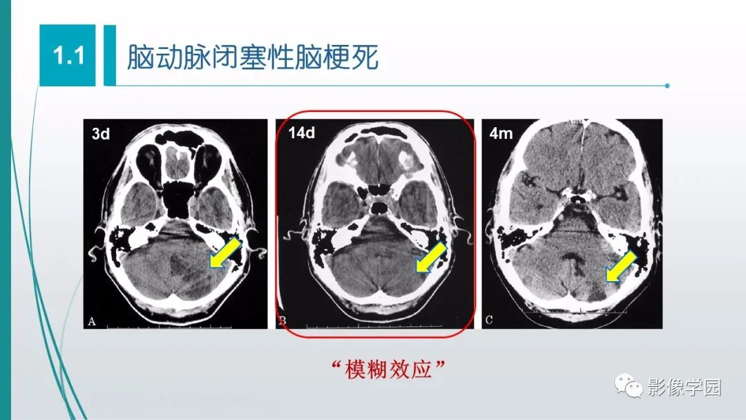 影像PPT - 【PPT】脑血管疾病的影像学诊断-12