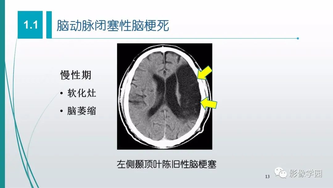 影像PPT - 【PPT】脑血管疾病的影像学诊断-14