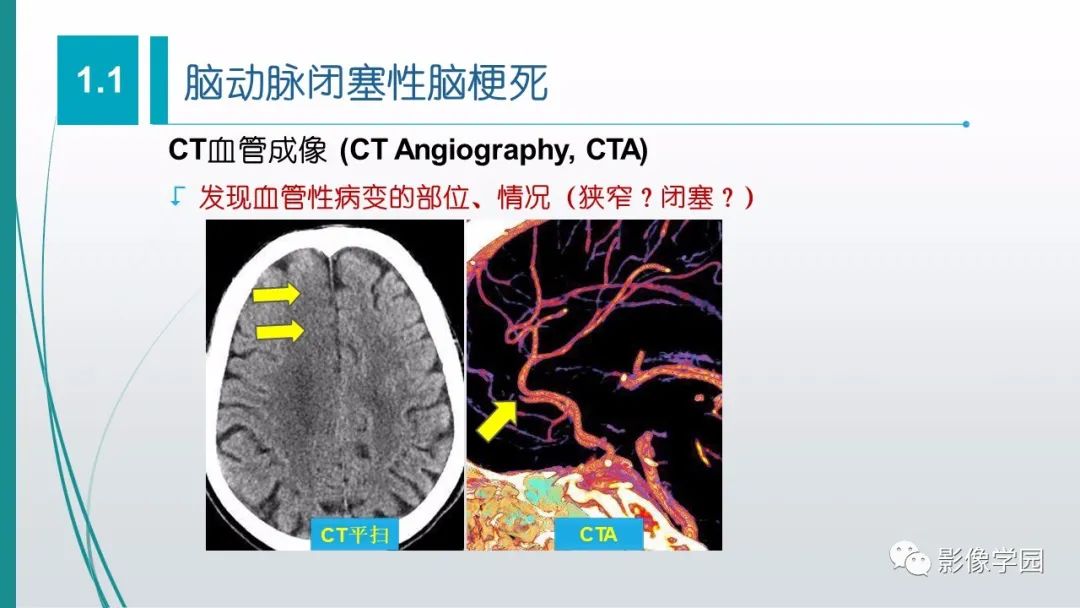 影像PPT - 【PPT】脑血管疾病的影像学诊断-15