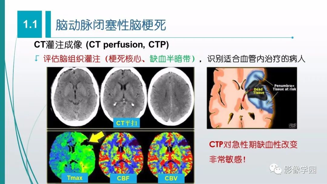 影像PPT - 【PPT】脑血管疾病的影像学诊断-16