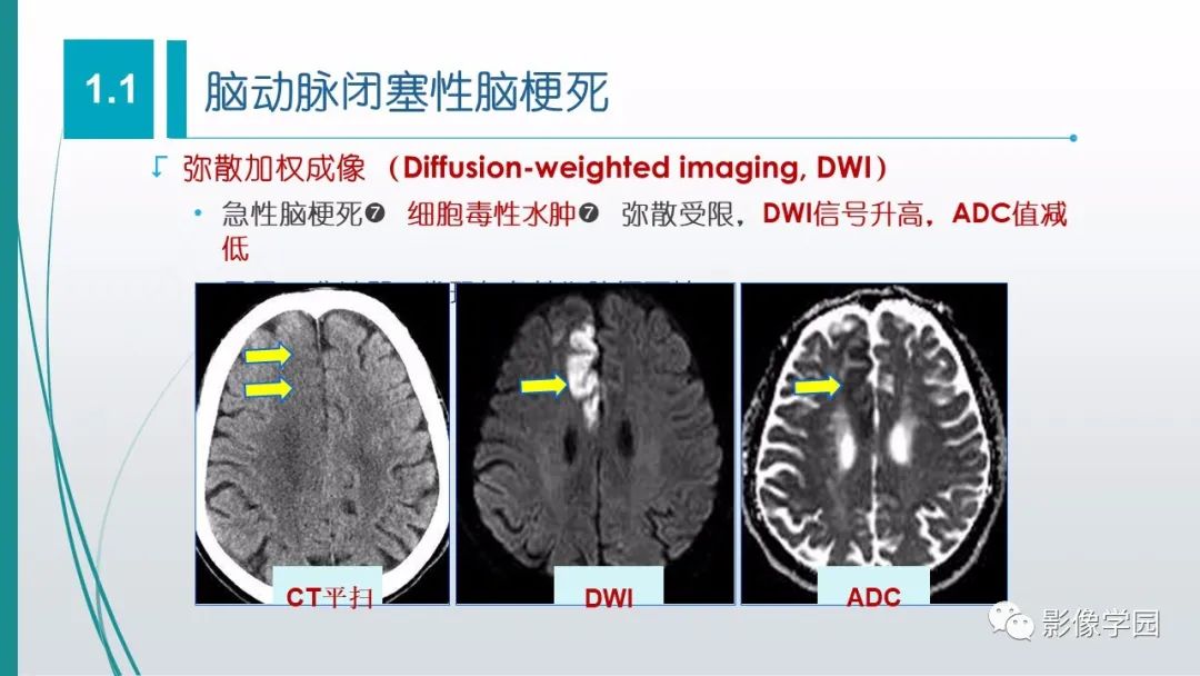 影像PPT - 【PPT】脑血管疾病的影像学诊断-18