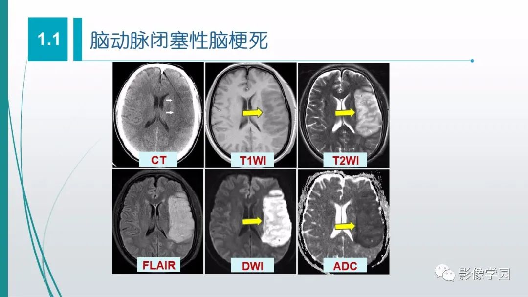 影像PPT - 【PPT】脑血管疾病的影像学诊断-19