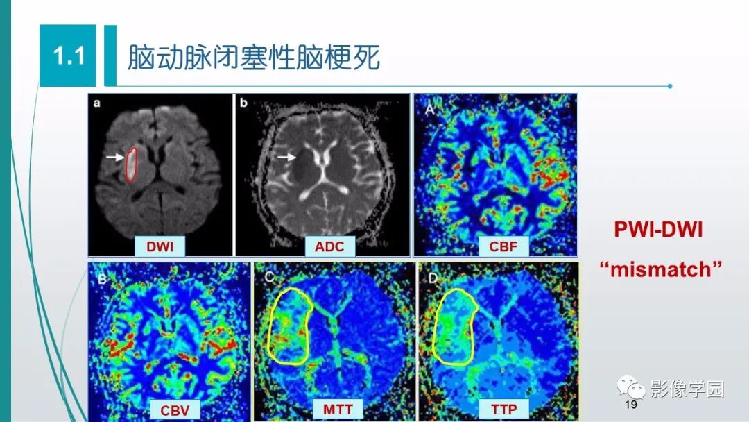 影像PPT - 【PPT】脑血管疾病的影像学诊断-20