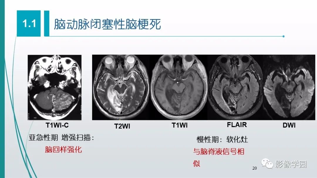影像PPT - 【PPT】脑血管疾病的影像学诊断-21