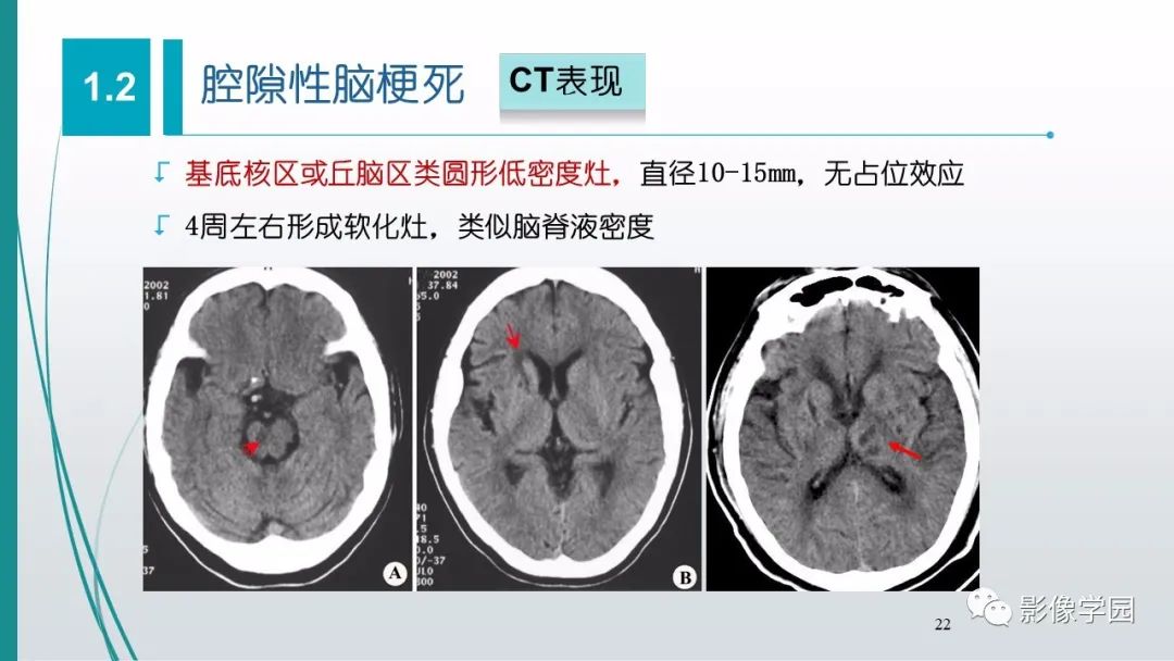 影像PPT - 【PPT】脑血管疾病的影像学诊断-23