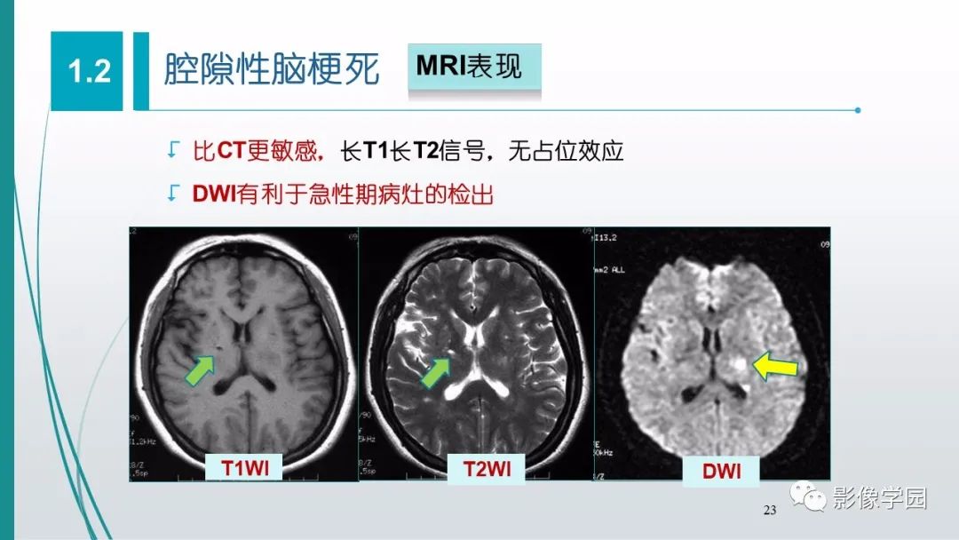 影像PPT - 【PPT】脑血管疾病的影像学诊断-24