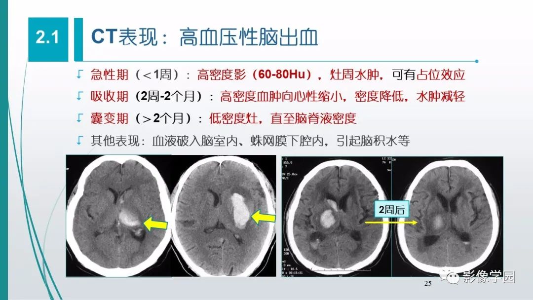 影像PPT - 【PPT】脑血管疾病的影像学诊断-26