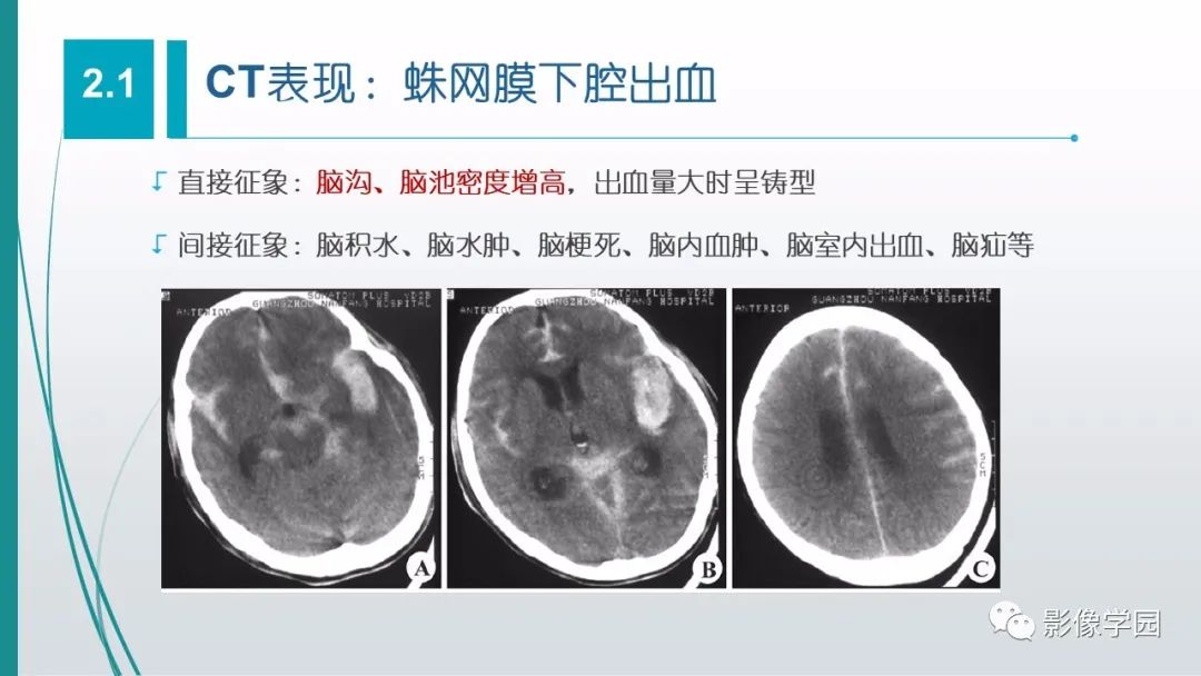 影像PPT - 【PPT】脑血管疾病的影像学诊断-27