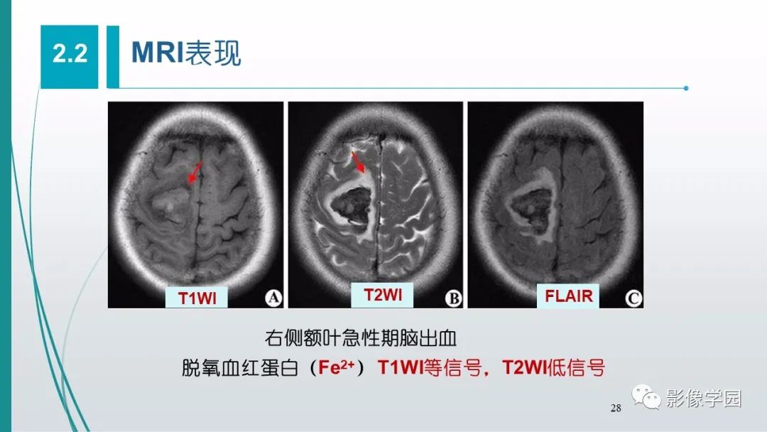 影像PPT - 【PPT】脑血管疾病的影像学诊断-29