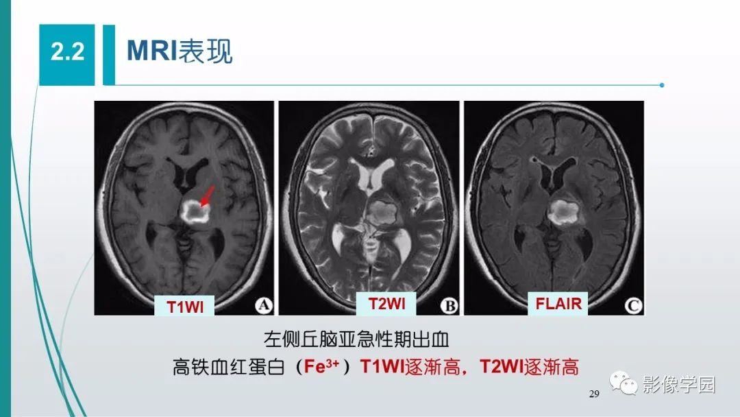 影像PPT - 【PPT】脑血管疾病的影像学诊断-30