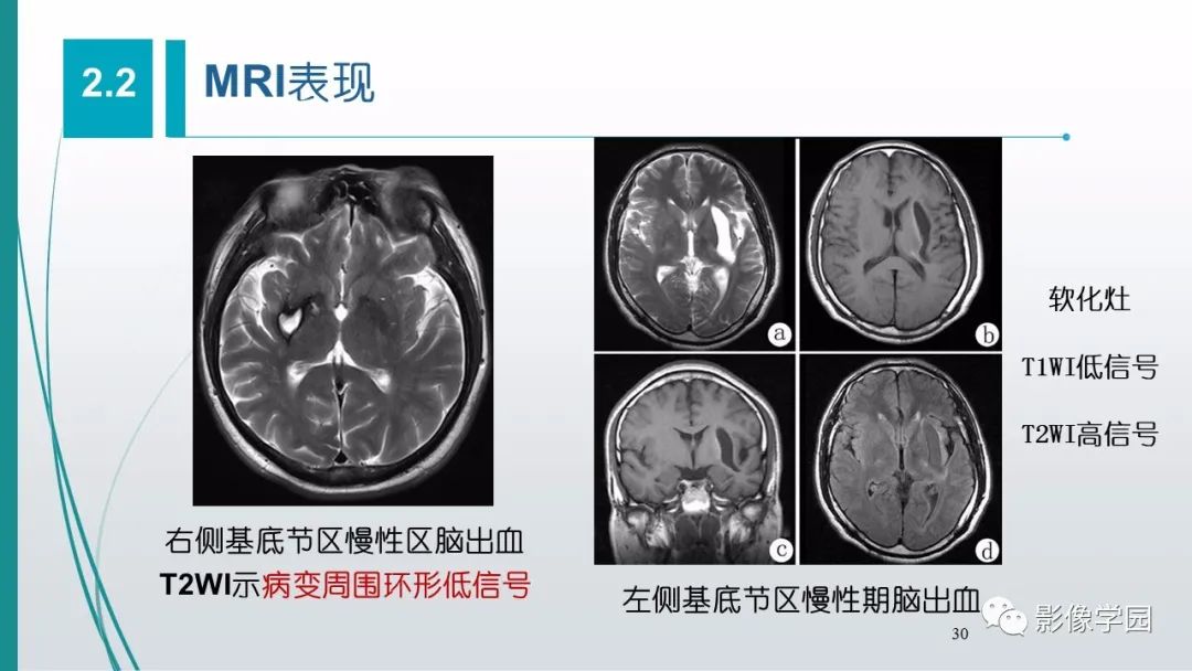 影像PPT - 【PPT】脑血管疾病的影像学诊断-31
