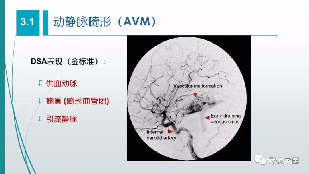 影像PPT - 【PPT】脑血管疾病的影像学诊断-34