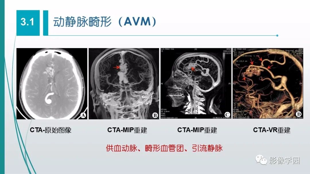 影像PPT - 【PPT】脑血管疾病的影像学诊断-35