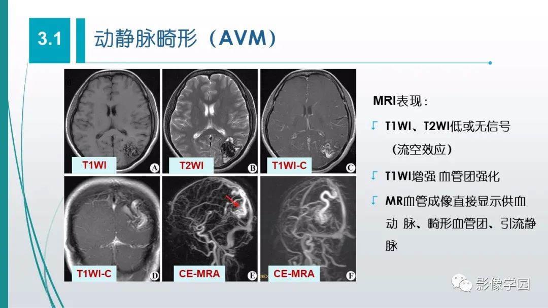 影像PPT - 【PPT】脑血管疾病的影像学诊断-36