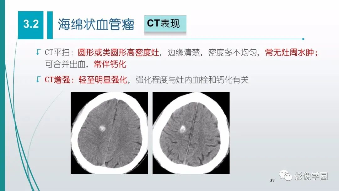 影像PPT - 【PPT】脑血管疾病的影像学诊断-38
