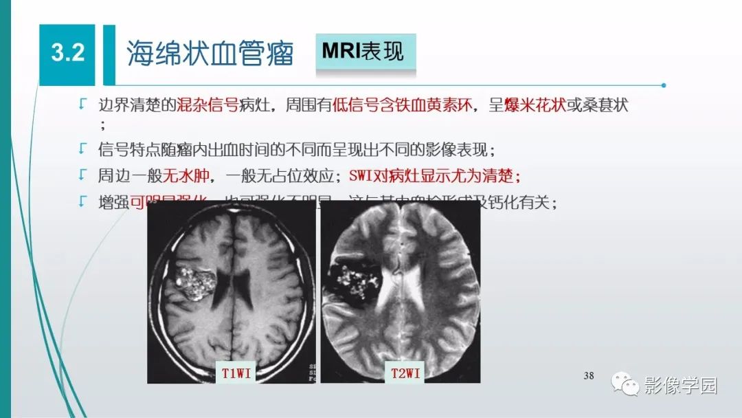 影像PPT - 【PPT】脑血管疾病的影像学诊断-39