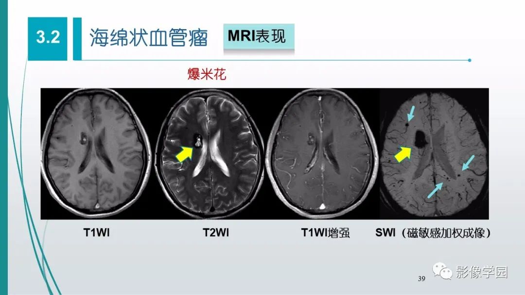 影像PPT - 【PPT】脑血管疾病的影像学诊断-40