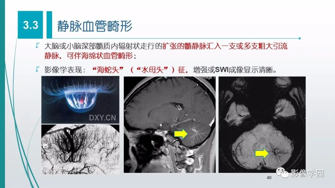 影像PPT - 【PPT】脑血管疾病的影像学诊断-41