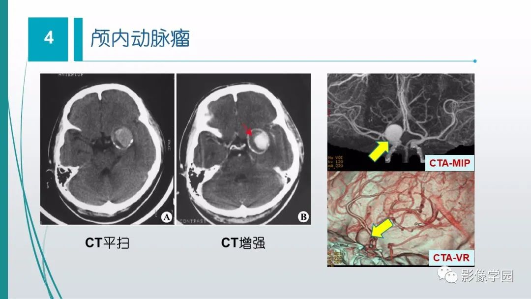 影像PPT - 【PPT】脑血管疾病的影像学诊断-44