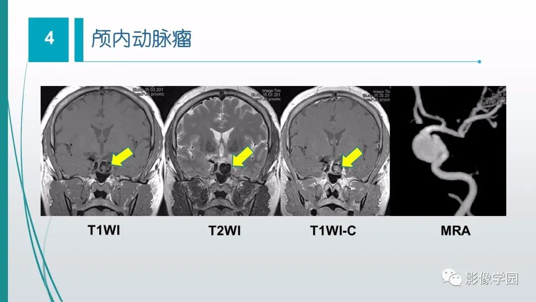 影像PPT - 【PPT】脑血管疾病的影像学诊断-45