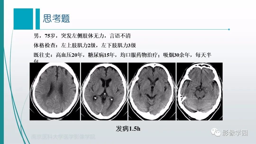 影像PPT - 【PPT】脑血管疾病的影像学诊断-48