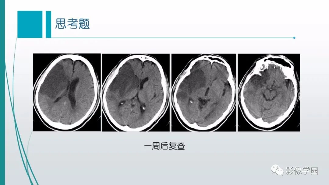 影像PPT - 【PPT】脑血管疾病的影像学诊断-49