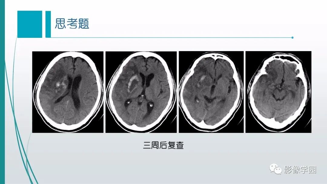 影像PPT - 【PPT】脑血管疾病的影像学诊断-50