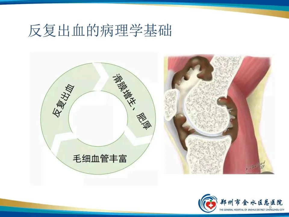 影像PPT - 【PPT】色素沉着绒毛结节性滑膜炎-6