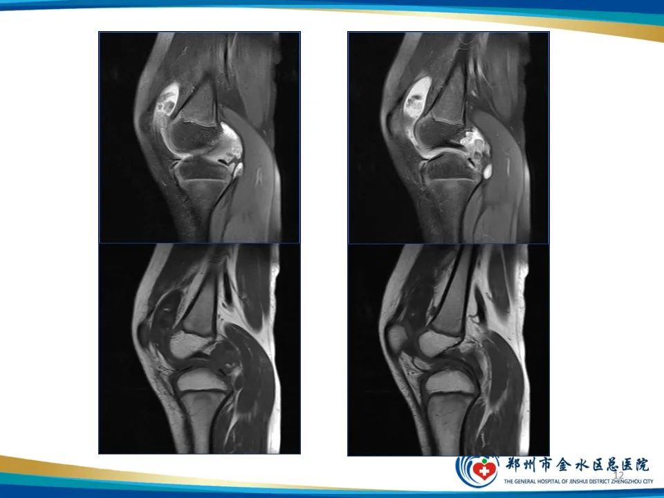 影像PPT - 【PPT】色素沉着绒毛结节性滑膜炎-12