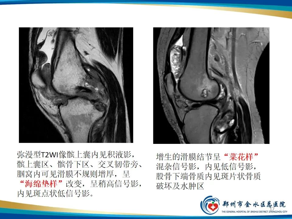 影像PPT - 【PPT】色素沉着绒毛结节性滑膜炎-17