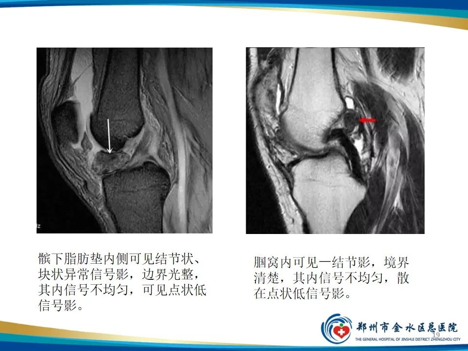影像PPT - 【PPT】色素沉着绒毛结节性滑膜炎-19