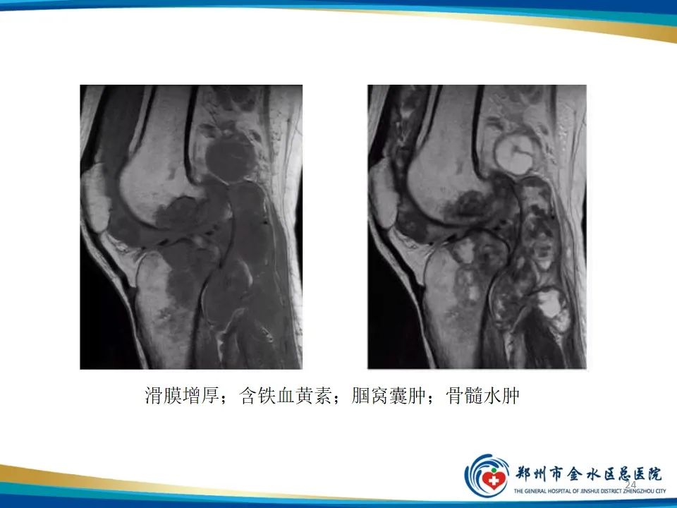 影像PPT - 【PPT】色素沉着绒毛结节性滑膜炎-24